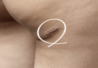 古い機器による失敗跡を最新機器で治療します